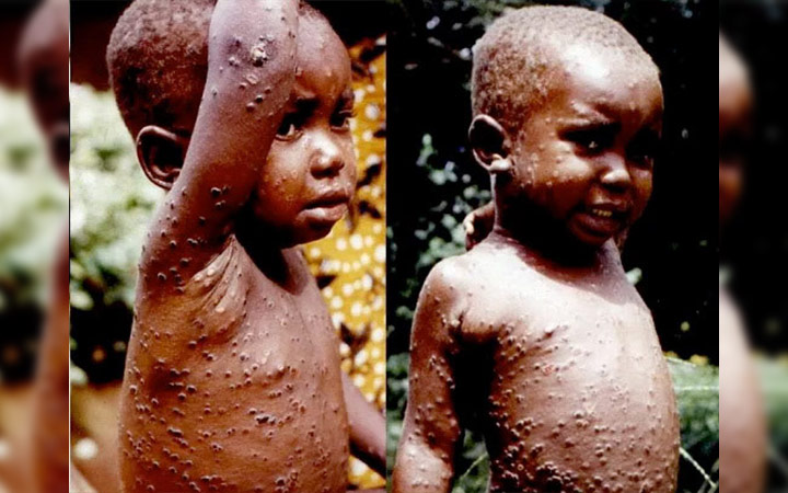 dr-marcel-ibrahim-keita-voici-ce-qu-il-faut-faire-pour-se-proteger-du-mpox