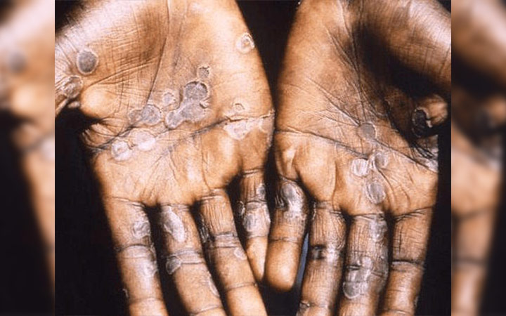 dr-marcel-ibrahim-keita-voici-ce-qu-il-faut-faire-pour-se-proteger-du-mpox